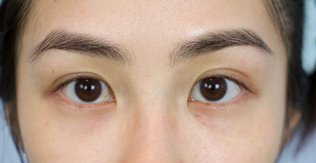 Korean eye treatment review